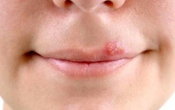 Rộp môi có lây không?