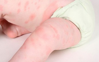 Trẻ bị dị ứng sữa bò, phải làm gì?