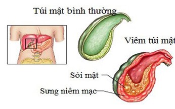 Vi&#234;m t&#250;i mật và những nguy bi&#234;́n