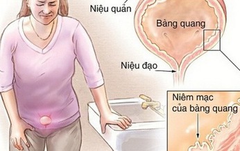 Cảnh gi&#225;c với vi&#234;m b&#224;ng quang mạn t&#237;nh