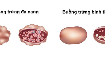 T&#225;c hại do dậy th&#236; sớm ở b&#233; g&#225;i