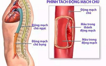 Dấu hiệu nghi ngờ ph&#236;nh mạch chủ bụng