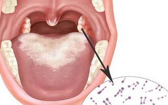 Những điều cần lưu &#253; khi d&#249;ng thuốc trị bạch hầu