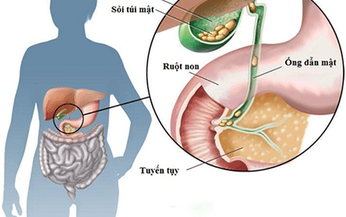 &#193;p-xe gan đường mật c&#243; nguy hiểm?