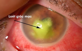 Vi&#234;m lo&#233;t gi&#225;c mạc nhiễm khuẩn: Nguy cơ cao g&#226;y m&#249; l&#242;a