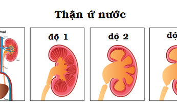 C&#225;ch ph&#225;t hiện sớm thận ứ nước