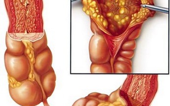 Cảnh gi&#225;c với bệnh lao ruột