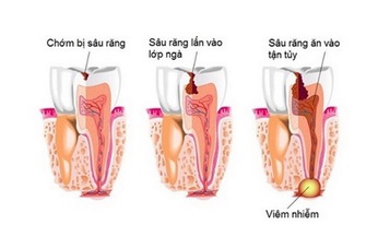 Đề phòng biến chứng viêm xương tủy hàm