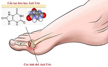 Xử tr&#237; tăng acid uric m&#225;u