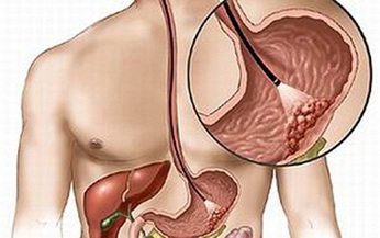 Chủ động tầm so&#225;t u Carcinoid đường ti&#234;u h&#243;a