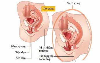 Sa sinh dục, bệnh kh&#243; n&#243;i...