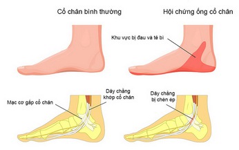 Chớ chủ quan với hội chứng đường hầm cổ ch&#226;n