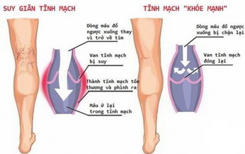 Hệ lụy do suy gi&#227;n tĩnh mạch