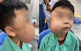 Chớ chủ quan với u xơ v&#242;m mũi họng