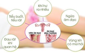 Ngừa vi&#234;m &#226;m đạo ở phụ nữ