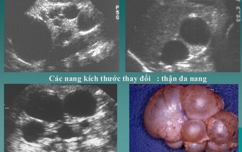 Bệnh thận đa nang c&#243; nguy hiểm?