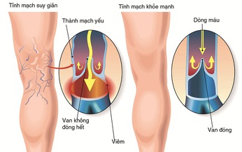 Đ&#244;ng y chữa suy gi&#227;n tĩnh mạch ch&#226;n