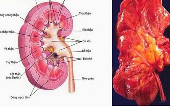 Dấu hiệu vi&#234;m cầu thận cấp