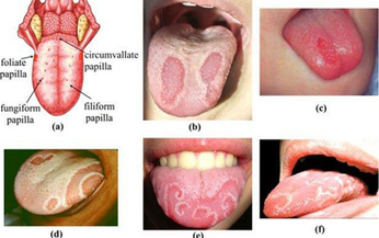 Xử trí vi&#234;m lưỡi bản đồ