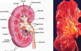 B&#224;i thuốc hỗ trợ trị vi&#234;m cầu thận cấp