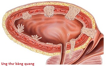 Điểm mặt c&#225;c yếu tố nguy cơ g&#226;y ung thư b&#224;ng quang