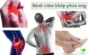 Chữa trị sớm vi&#234;m khớp phản ứng đ&#234;̉ tránh bi&#234;́n chứng