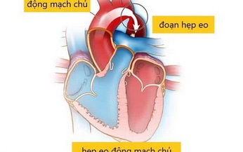 Hẹp eo động mạch chủ: Ti&#234;n lượng tốt nếu chẩn đo&#225;n sớm