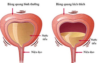 Thuốc g&#236; khắc phục hội chứng b&#224;ng quang tăng hoạt?