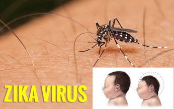 Vi r&#250;t Zika c&#243; li&#234;n quan thế n&#224;o với chứng đầu nhỏ ?