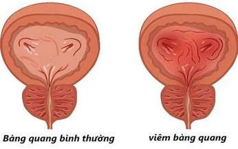 C&#243; thể r&#250;t ngắn ph&#225;c đồ kh&#225;ng sinh trị vi&#234;m b&#224;ng quang cấp ở phụ nữ