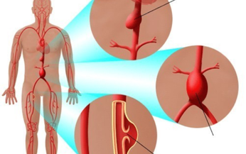 Cẩn trọng với nguy cơ ph&#236;nh động mạch chủ khi d&#249;ng fluoroquinolon