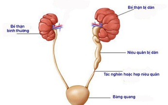 Điều trị hẹp niệu quản với “vũ kh&#237;” mới