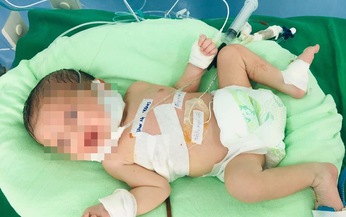 Lần đầu bệnh viện tỉnh cứu sống bé 2 ngày tuổi teo thực quản bẩm sinh