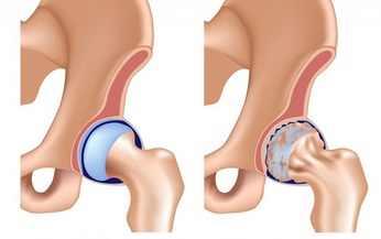 Tho&#225;i h&#243;a khớp h&#225;ng