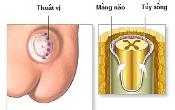 Tho&#225;t vị m&#224;ng n&#227;o tủy