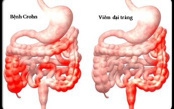 5 c&#225;ch giảm triệu chứng bệnh Crohn kh&#244;ng cần thuốc