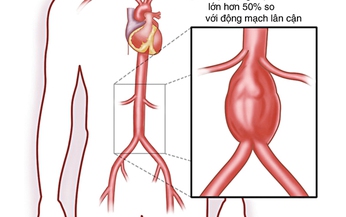 Ph&#236;nh động mạch chủ bụng