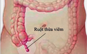 Dấu hiệu vi&#234;m ruột thừa?