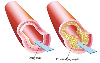 Cách nhìn mới về xơ vữa động mạch