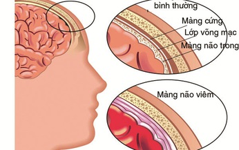 Tác nh&#226;n g&#226;y vi&#234;m m&#224;ng n&#227;o mủ