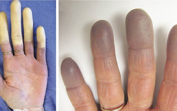 C&#225;c thuốc điều trị hội chứng Raynaud