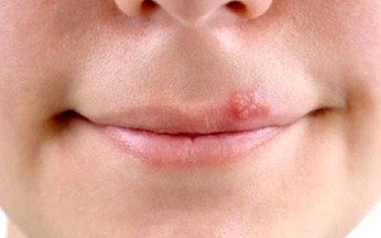 Mụn rộp ở môi, dùng thuốc gì?