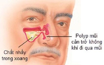 Polyp mũi c&#243; nguy hiểm?