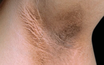 Acanthosis Nigricans l&#224; bệnh g&#236;?