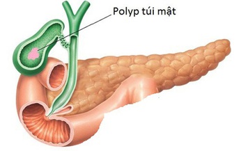 Polyp túi mật, khi nào cần điều trị?