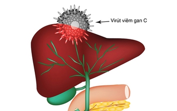 Vi&#234;m gan si&#234;u vi C  v&#224; c&#225;c biến chứng  thường gặp