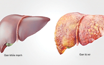 Quản l&#253; v&#224; chăm s&#243;c l&#226;u d&#224;i người bệnh xơ gan