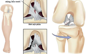 Nhận biết mất vững khớp gối do tổn thương d&#226;y chằng ch&#233;o trước