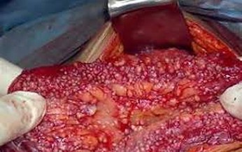 Bạn biết gì về lao phúc mạc?