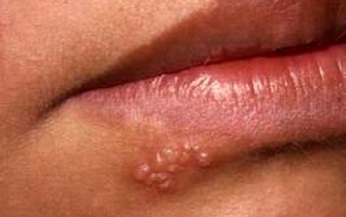 Bệnh do virut Herpes: Chữa trị thế n&#224;o?